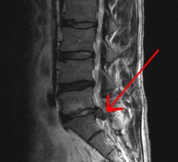 Herniated disc on MRI of lower back