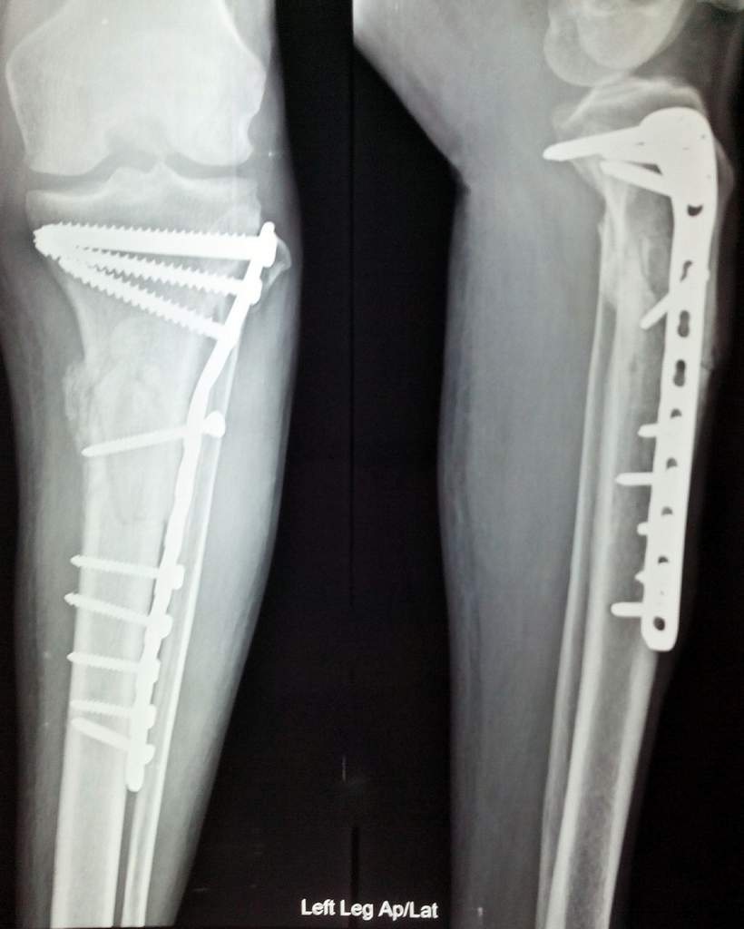 X ray internal fixation leg (tibia) fracture