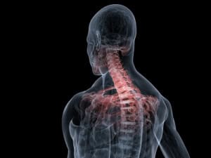 Hernia Discal Indemnizaciones : Accidentes Lesiones Florida : Auto Camión Motocicleta Choque Resbalón Caída