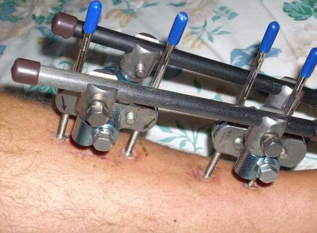External fixator in tibia (shinbone) shaft