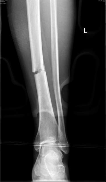 Tibia fracture 