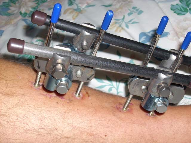 close up external fixator in lower leg.