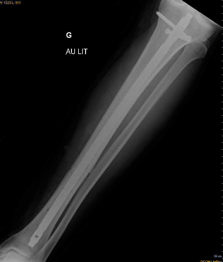 X-ray after the external fixator was removed from leg. Rod and screws remain.