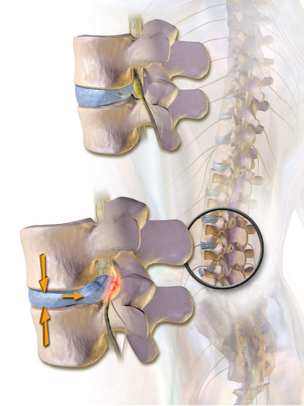 Herniated Disc.