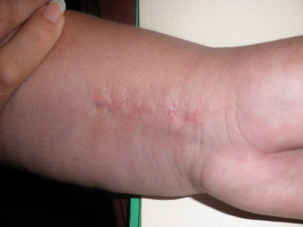 Scarring on the forearm near the wrist after surgery from a car accident