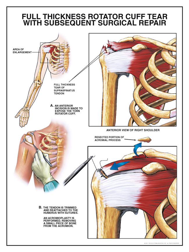 Full Thickness Rotator Cuff Tear with Subsequent Surgery