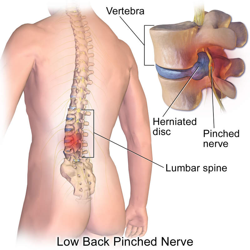 Low Back Pinched Nerve, Vertebra, Herniated disc, Lumbar