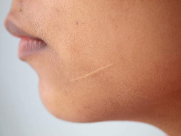 Scar on lady's face 