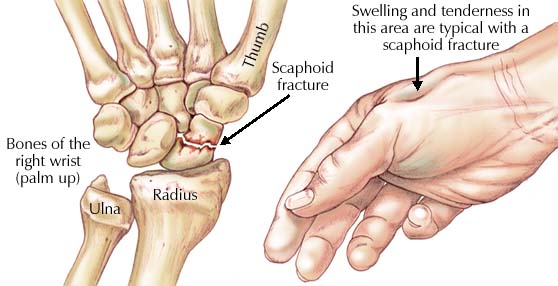 wrist fracture - scaphoid