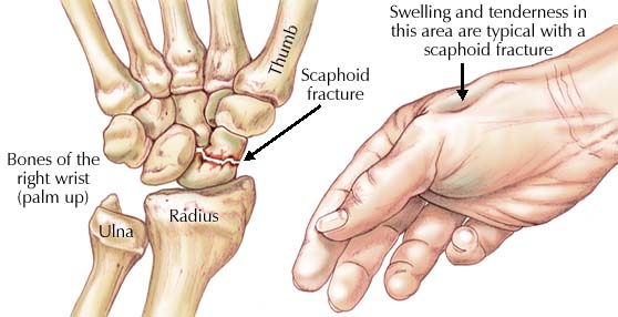 scaphoid fracture cast time