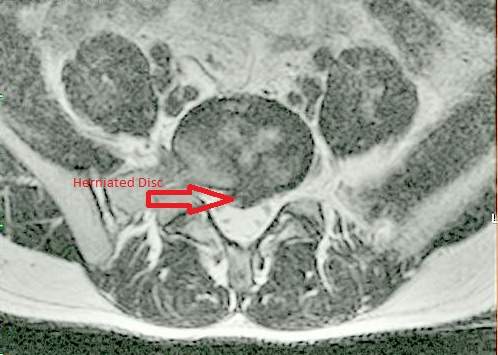 Arrow pointing to herniated disc in lower back.