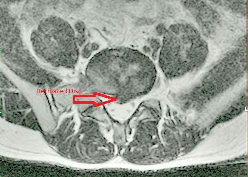 Claimed herniated disc from a car crash.