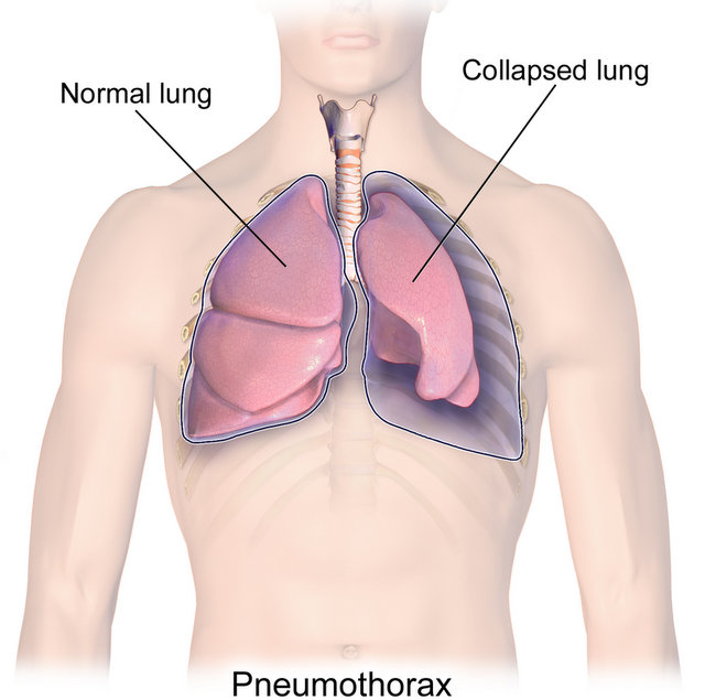Collapsed lung (Pneumothorax)