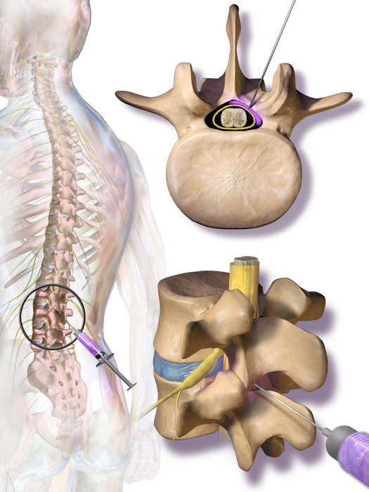 Epidural steroid injection.