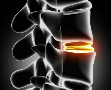 Pre-existing Injury in herniated disc. 