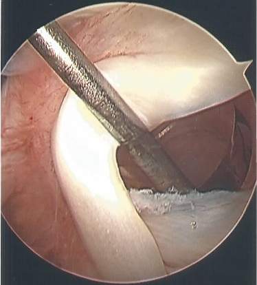 Picture taken of inside of shoulder during rotator cuff surgery.