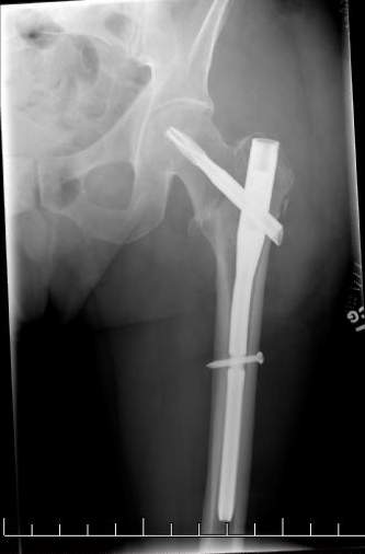 2 Rods and screw in femur for intertrochanteric hip fracture from fall