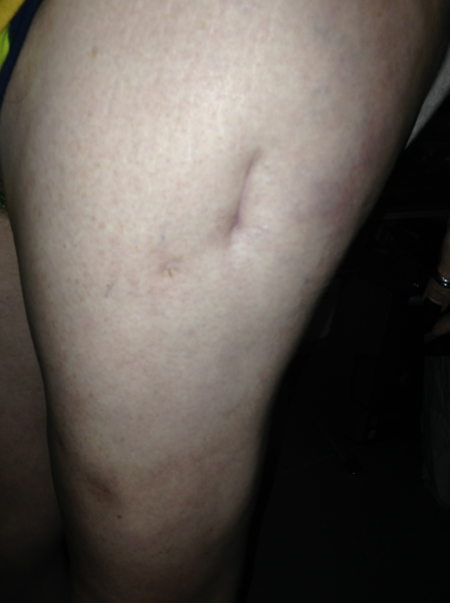 Permanent scar from hip surgery.