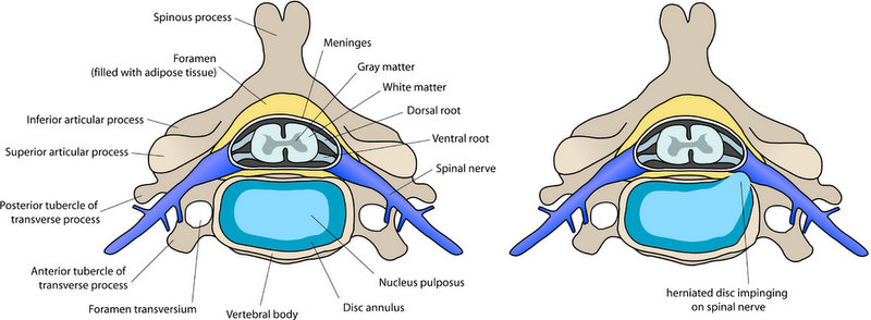 Herniated disc impinging on spinal nerve Anterior cervical discectomy and fusion