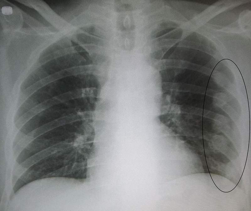 An x-ray showing multiple fractured ribs.