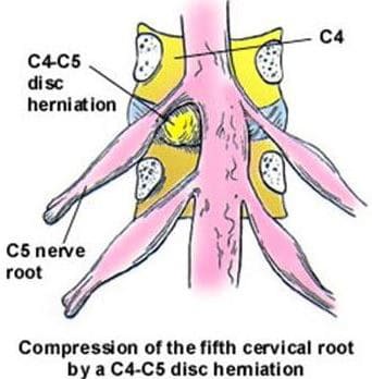 C4-C5 disc herniation 