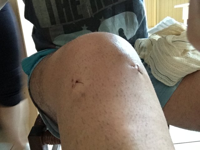 Incisions after arthroscopic surgery on his meniscus.