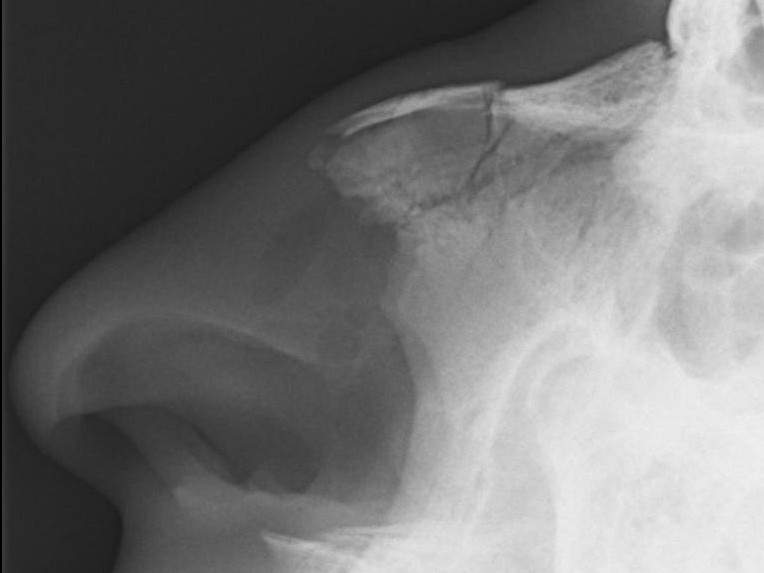 X-Ray imaging nasal bone fracture