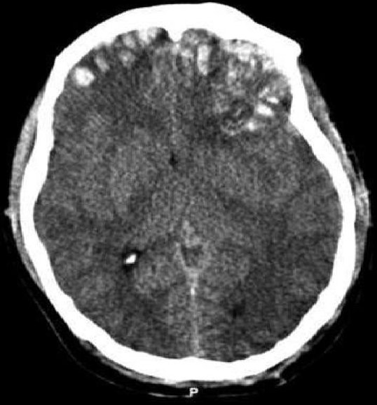 CT scan of patient with brain trauma