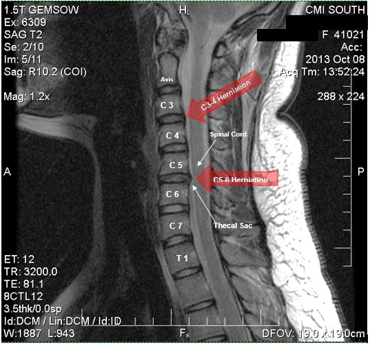 c3-c4 herniation and c5-c6 herniation