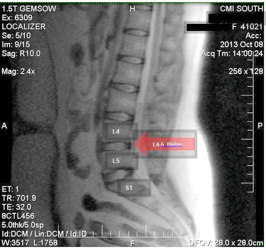 L4-L5 Disc Bulge on MRI from an accident case