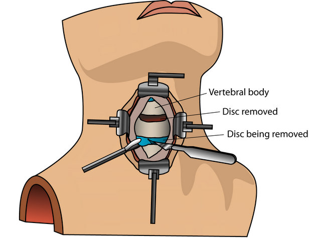 Anterior cervical discectomy and fusion (ACDF)