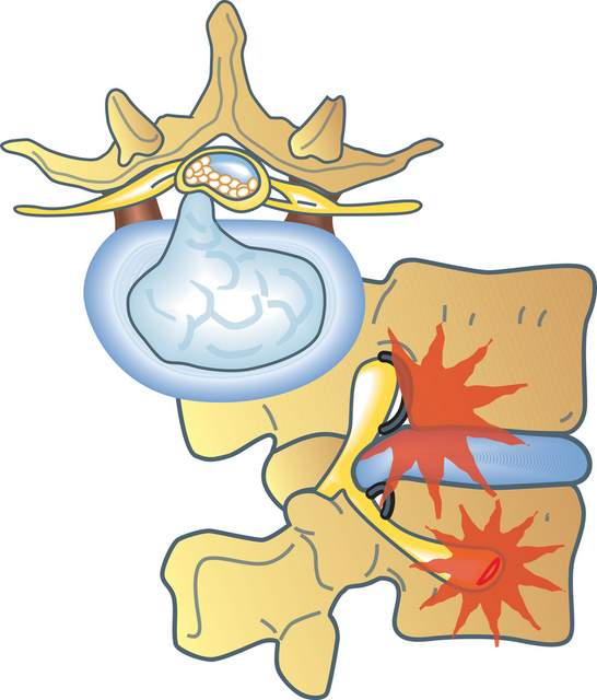 Herniated disc