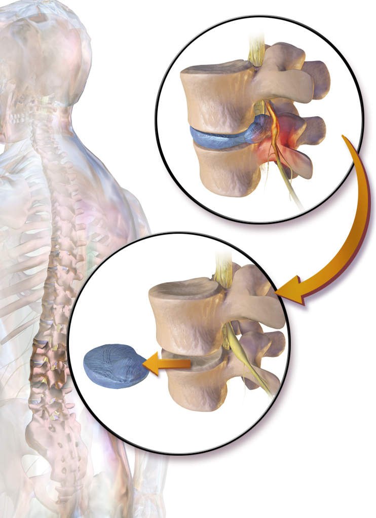 Lumbar (Lower Back) Discectomy Surgery