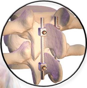 Harrington Rod used in spinal fusion