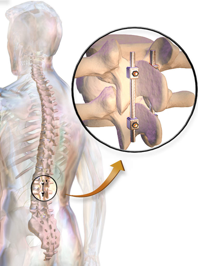 Harrington Rods in lower back fusion