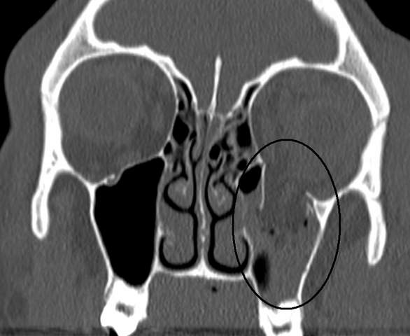 An orbital blowout fracture of the floor of the left orbit.