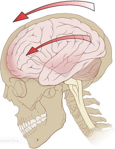 Concussion mechanics