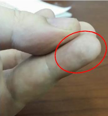 finger tip discolored