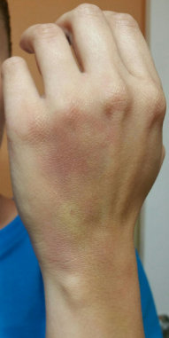 Wrist Bruise