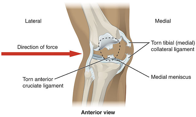 Lateral trauma to the knee can cause torn medial collateral ligaments, cruciate ligament injury as well as meniscus injury.