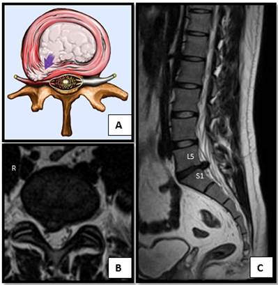 Nucleus herniating through tear in anNulus (with MRI)
