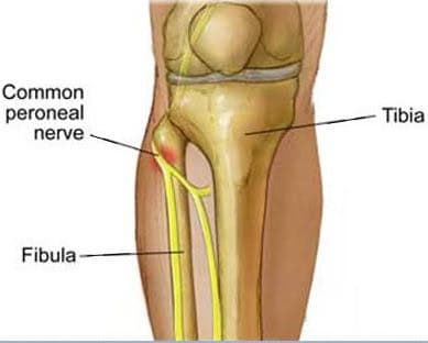 Displaced tibial plateau fracture recovery