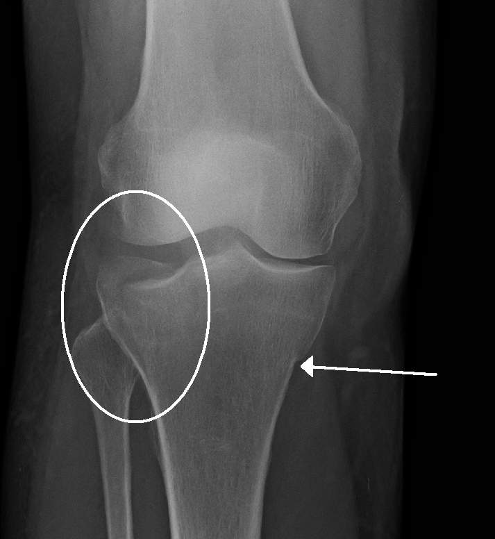 Tibia Plateau Fracture