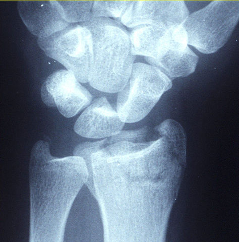 X-ray of a displaced intra-articular distal radius fracture