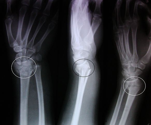 X-ray image of fractured radius showing a Colles' fracture