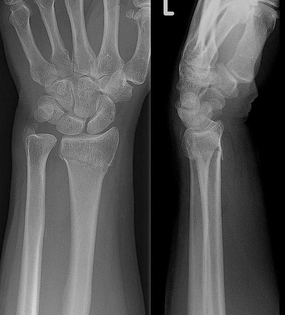 Distal radius fracture. X-ray of Colles fracture on left wrist