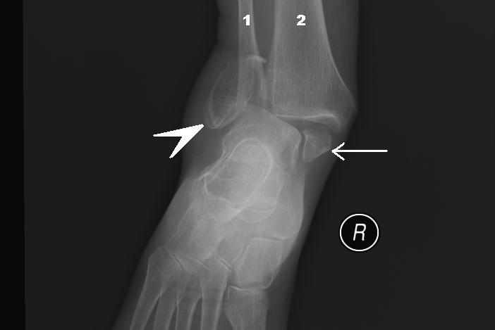 Bimalleolar fracture and right ankle dislocation