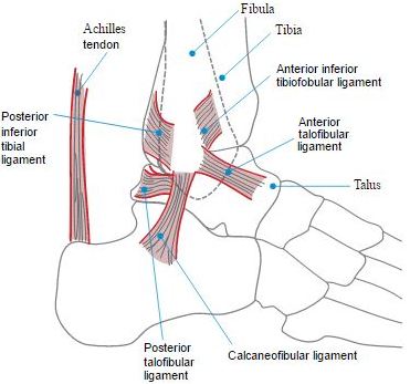 Ankle sprain