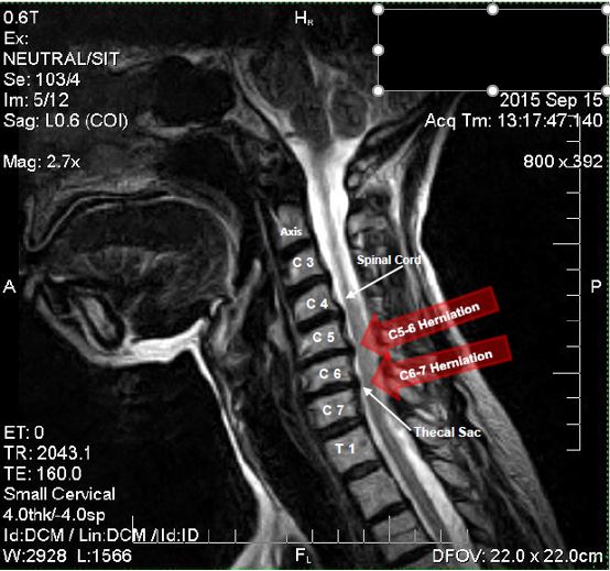herniated discs in the neck at C5-6 and C6-7, both compressing the spinal cord