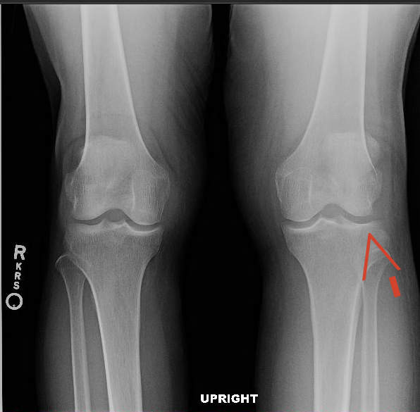 b. Acute fractures of the lateral tibial plateau with associated lipohemart...